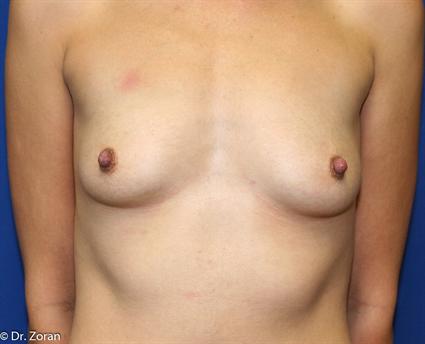 breast-augmentation-before