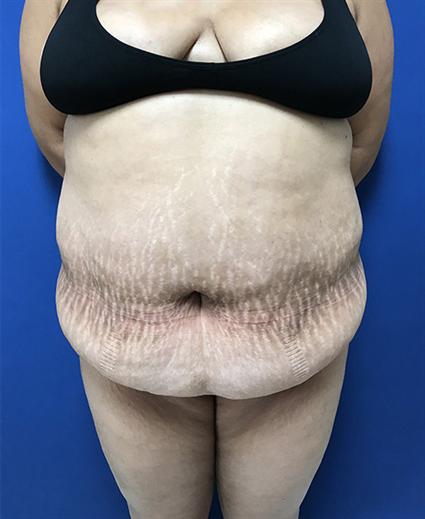 body contouring
