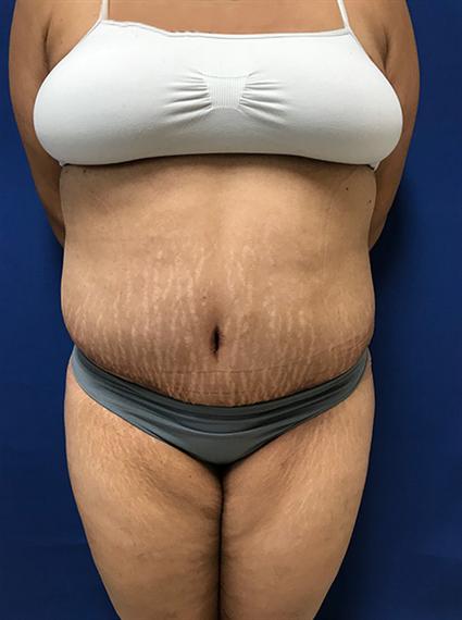 PANNICULECTOMY 403