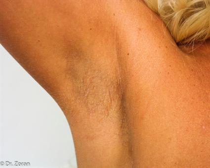 breast-augmentation-before