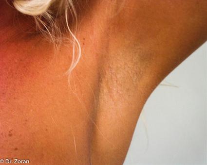 SCARLESS BREAST AUGMENTATION (TRANSAXILLARY SCAR) 42