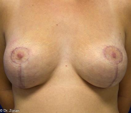 BREAST LIFT 53