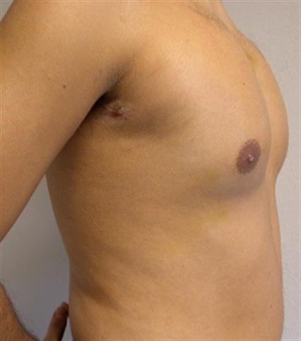 PECK IMPLANTS 56