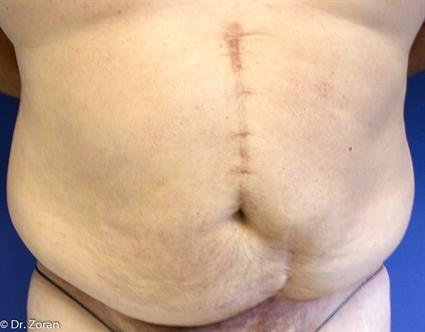 before male lower body lift