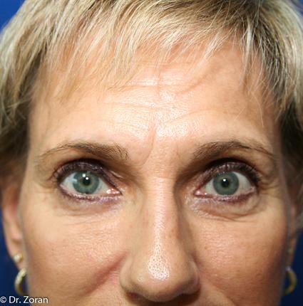 brow-lift-before