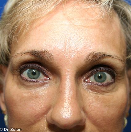 BROW LIFT CASE 88