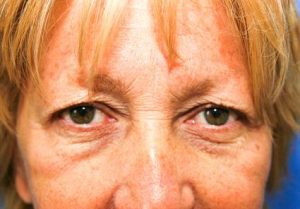 eyelid-surgery-blepharoplasty-before