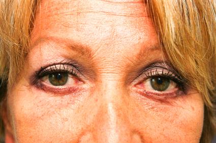 BLEPHAROPLASTY 9