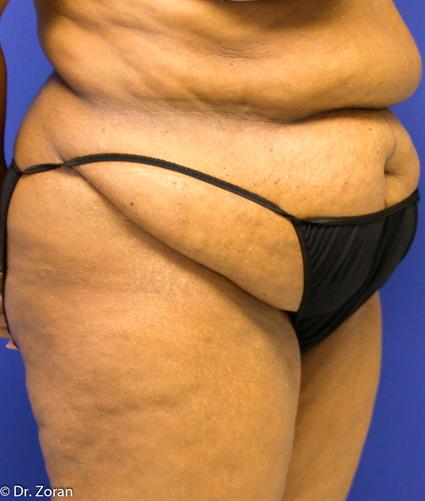 before female tummy tuck