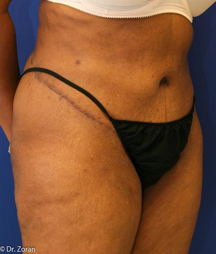 TUMMY TUCK - ABDOMINOPLASTY 91