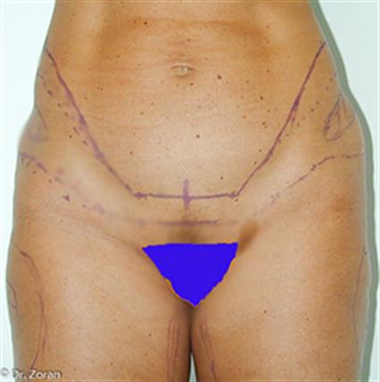 before lower body lift