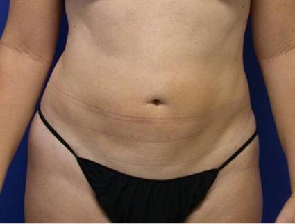 LIPOSUCTION 94