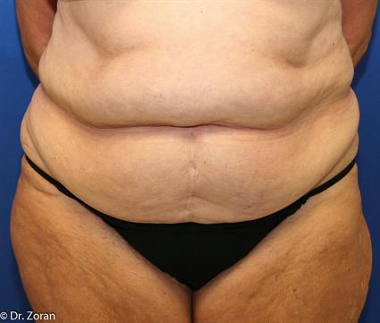 before tummy tuck