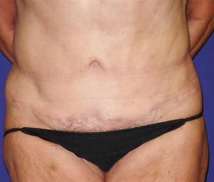TUMMY TUCK - ABDOMINOPLASTY CASE #99