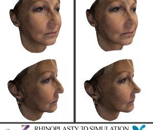 SEEING POSSIBLE RESULTS BEFORE THE ACTUAL SURGERY?