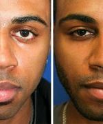 LIP REDUCTION – REALLY? IT’S A THING?