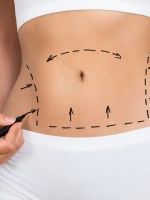 When to Consider Tummy Tuck Revision Surgery