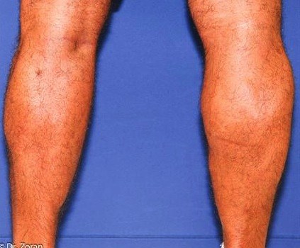 CALF IMPLANTS 18