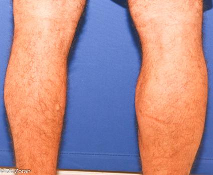 before male calf implants