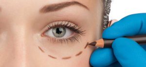 LET’S TALK ABOUT BLEPHAROPLASTY, BABY.