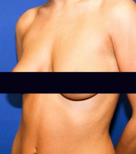 Before-breast-lift