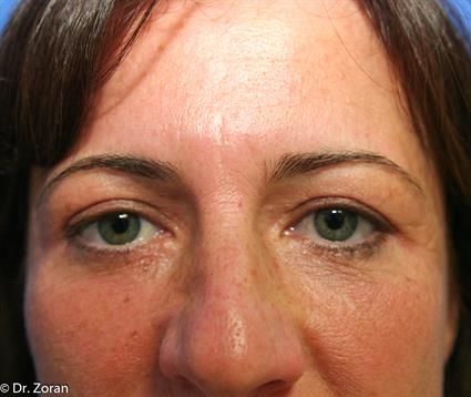 UPPER AND LOWER BLEPHAROPLASTY 10