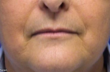 lip-procedure-before