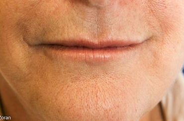 LIP CORNER LIFT - SMILE SURGERY 101