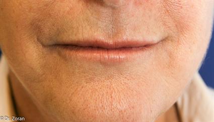 LIP CORNER LIFT - SMILE SURGERY 101