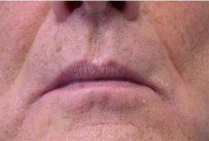 before-smile-surgery