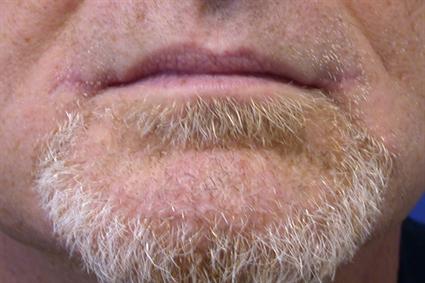 SMILE SURGERY - LIP LIFT CORNER 103