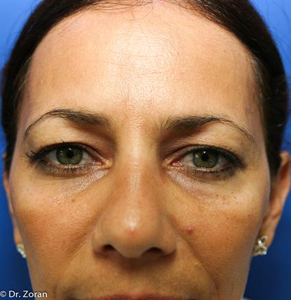 before female eyelid surgery