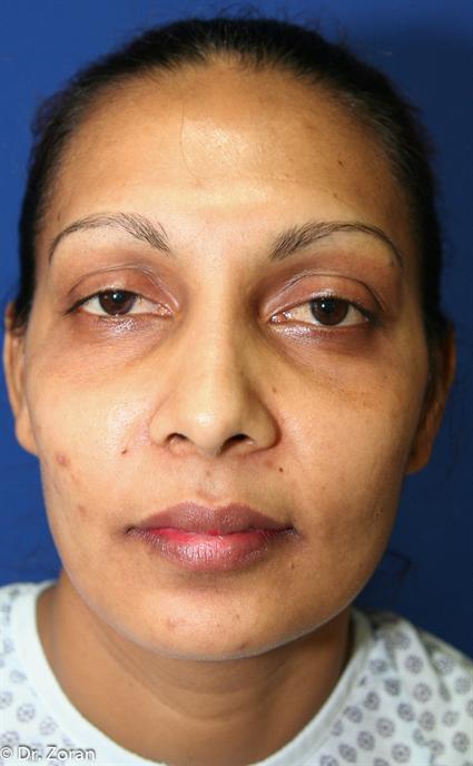 facial-fat-graft-before