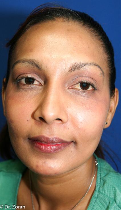FACIAL FATGRAFT 105