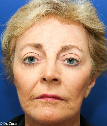 facial-fat-graft-before