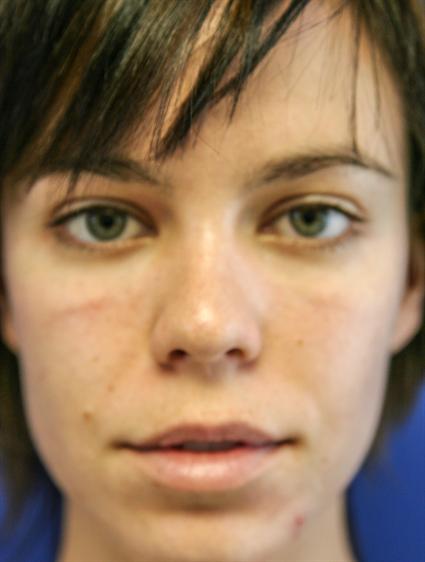 FAT GRAFTS - FACIAL 108