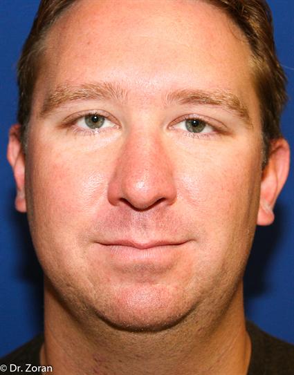 before-neck-liposuction-lipectomy