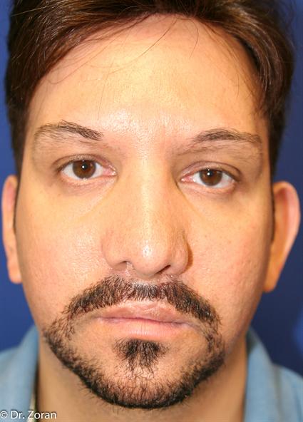 before male face cheek implants
