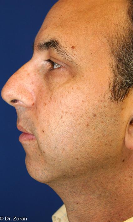 facial-chin-implants