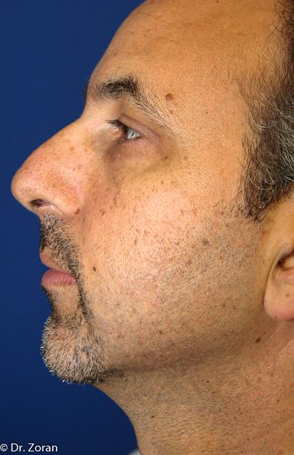 FACIAL IMPLANTS CHIN 111