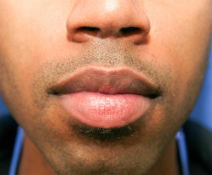 before-lip-procedure