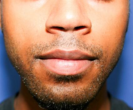 FACIAL IMPLANTS CHIN WITH LIP REDUCTION 112