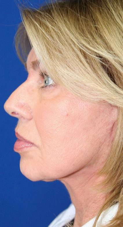 FACE LIFT AND NECK LIFT 114