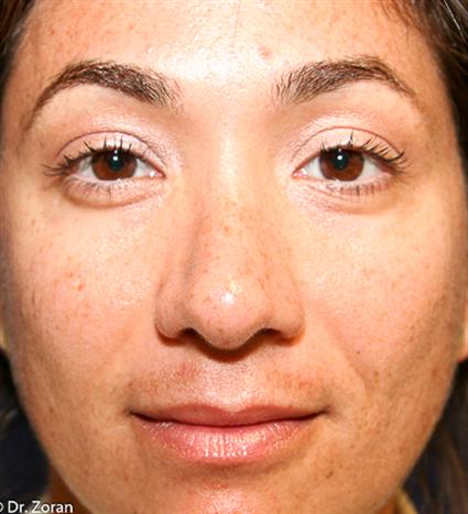 RHINOPLASTY - NOSE SURGERY 115