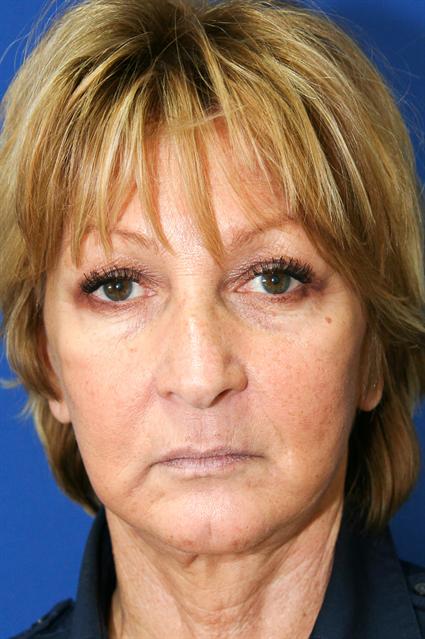 FACE LIFT AND NECK LIFT 116