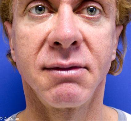 before-facial-cheek-implants