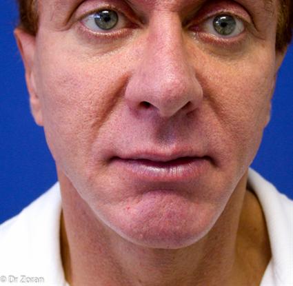FACIAL IMPLANTS CHEEK AFTER FACELIFTS 118