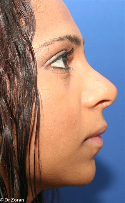 OPEN NOSE SURGERY 121