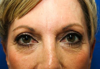 before-eyelid-surgery-blepharoplasty