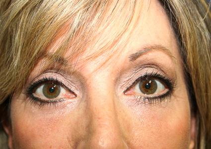 BLEPHAROPLASTY CASE 8